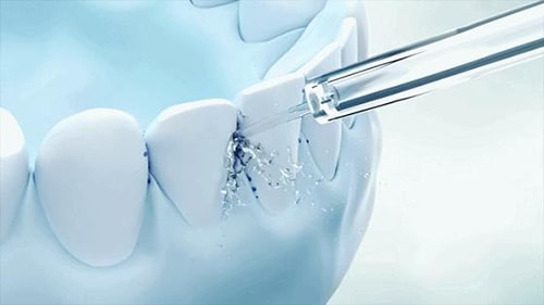 Buntáistí a bhaineann le flossers uisce le haghaidh braces wearers